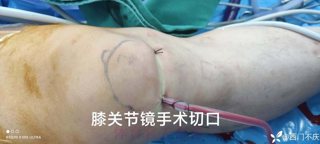 官方:阿拉巴成功接受了左膝内侧半月板撕裂手术 官方:阿拉巴成功接受了左膝内侧半月板撕裂手术